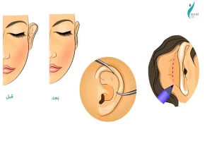مراحل عملية تصغير الأذن